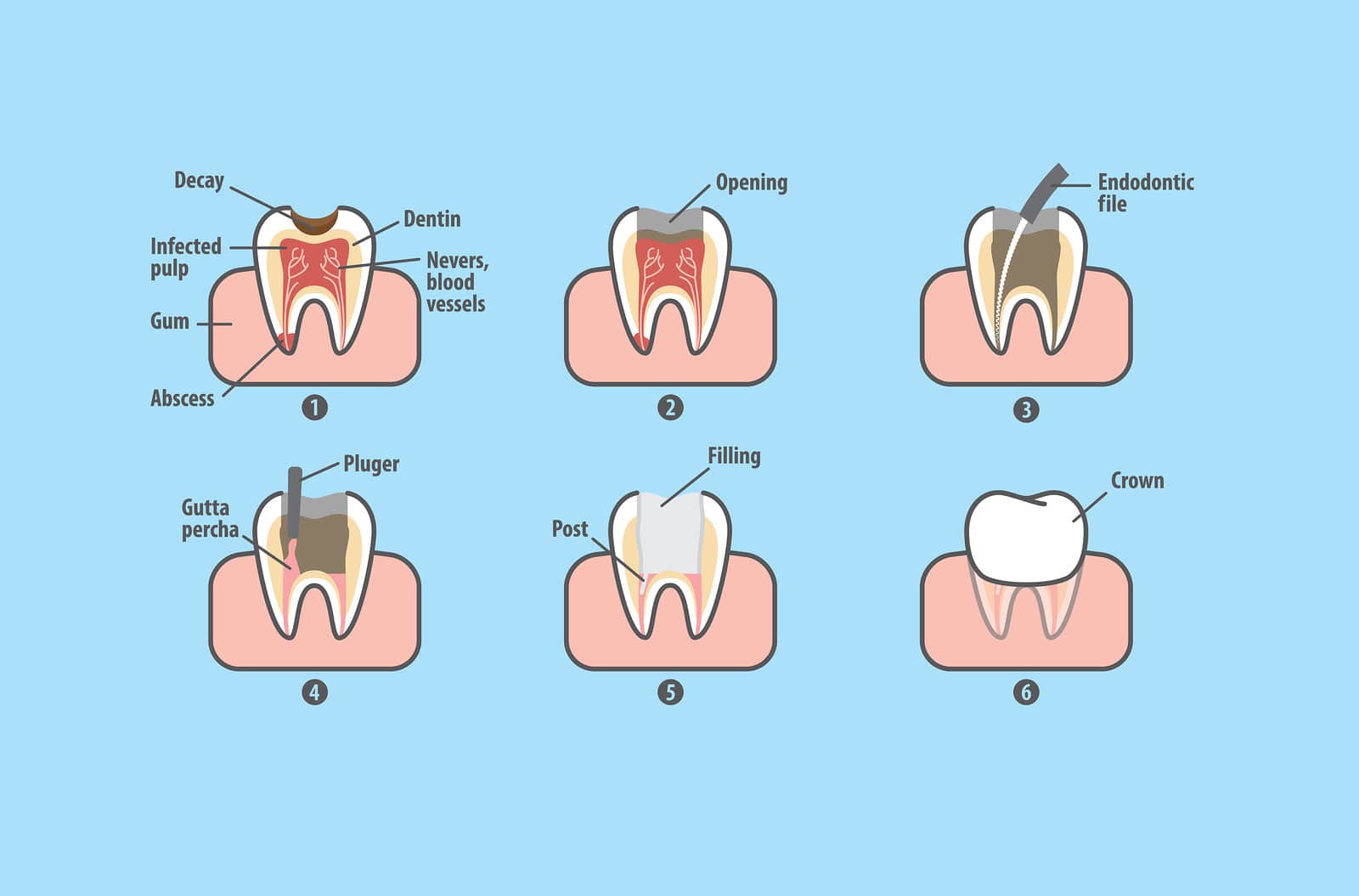 5 Most Common Myths About Root Canals College Drive Dental Associates